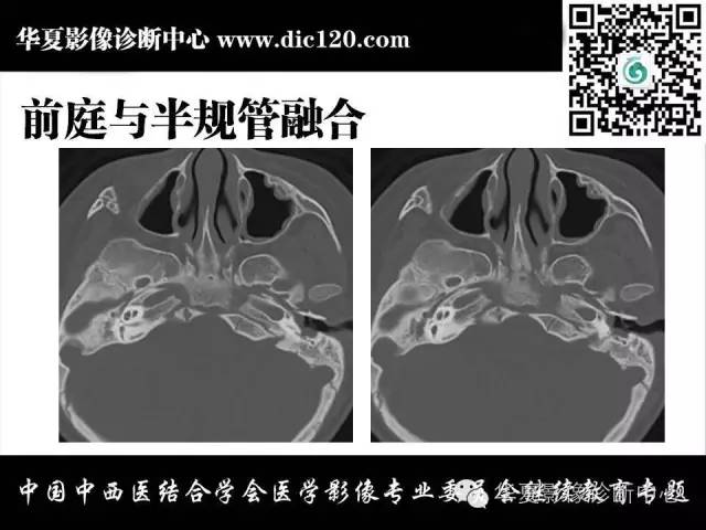 【PPT】耳部疾病的影像诊断和鉴别