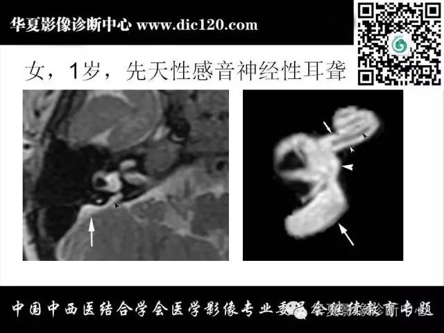 【PPT】耳部疾病的影像诊断和鉴别