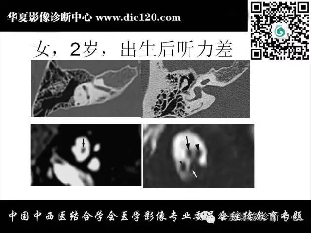 【PPT】耳部疾病的影像诊断和鉴别