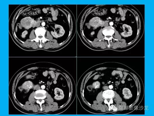 【病例】十二指肠间质瘤1例CT影像表现 【病例】十二指肠间质瘤1例CT影像表现