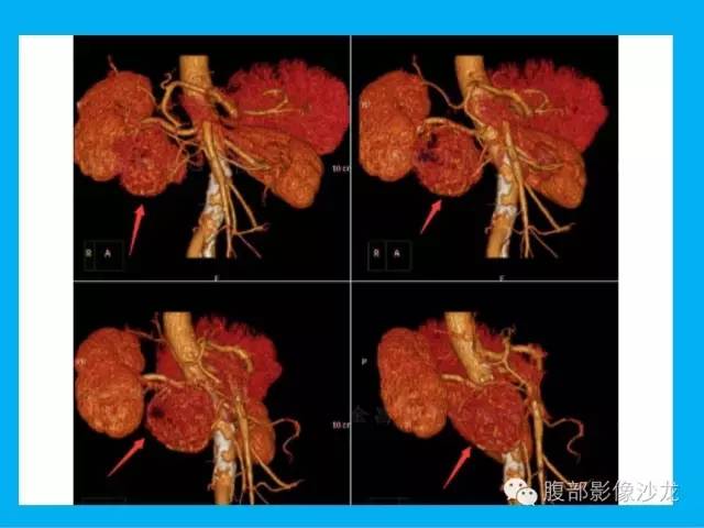 【病例】十二指肠间质瘤1例CT影像表现 【病例】十二指肠间质瘤1例CT影像表现