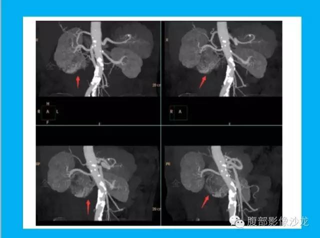 【病例】十二指肠间质瘤1例CT影像表现 【病例】十二指肠间质瘤1例CT影像表现