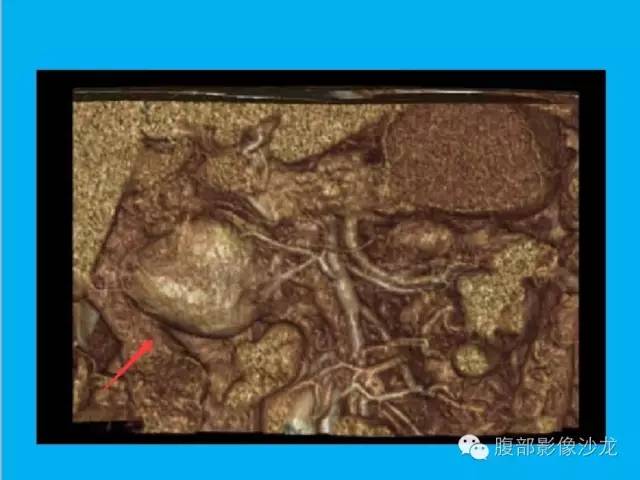 【病例】十二指肠间质瘤1例CT影像表现 【病例】十二指肠间质瘤1例CT影像表现