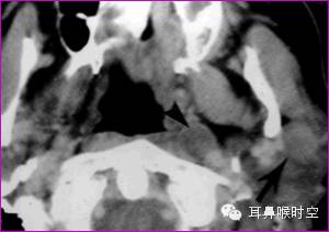 一起数数脖子上的这几种疾病