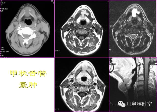 一起数数脖子上的这几种疾病