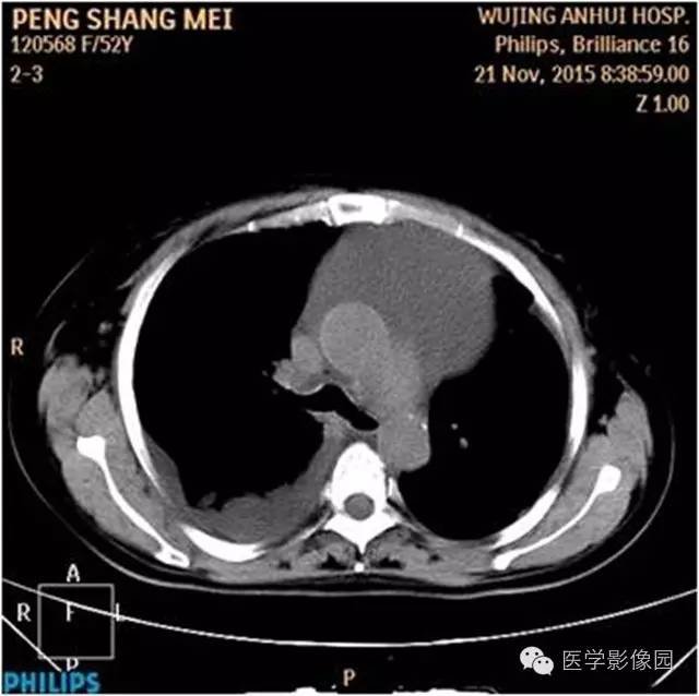 【病例】腹盆腔巨大转移瘤1例CT影像表现