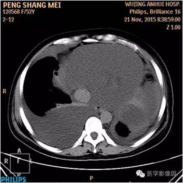 【病例】腹盆腔巨大转移瘤1例CT影像表现 【病例】腹盆腔巨大转移瘤1例CT影像表现