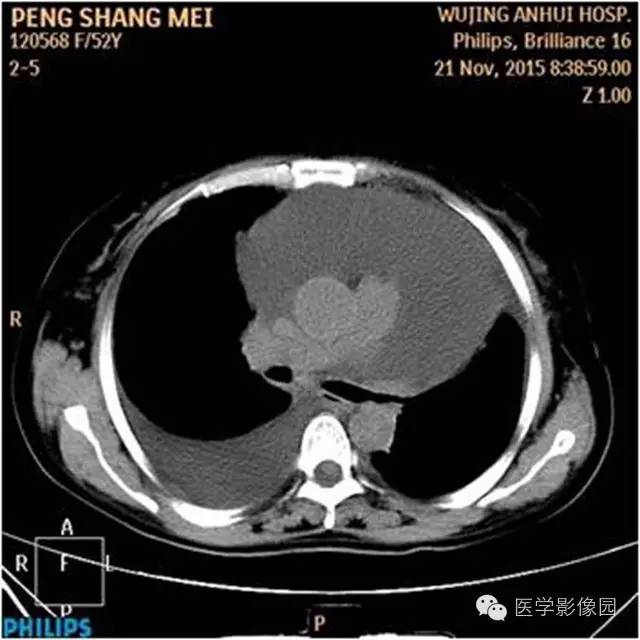 【病例】腹盆腔巨大转移瘤1例CT影像表现 【病例】腹盆腔巨大转移瘤1例CT影像表现