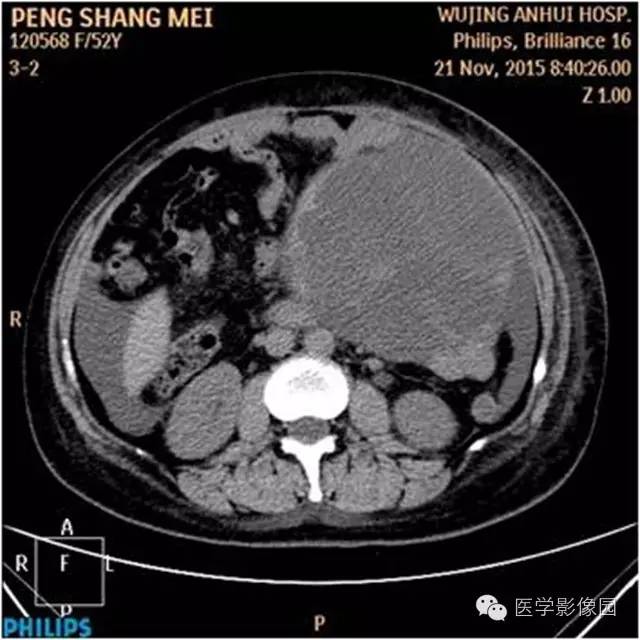 【病例】腹盆腔巨大转移瘤1例CT影像表现 【病例】腹盆腔巨大转移瘤1例CT影像表现