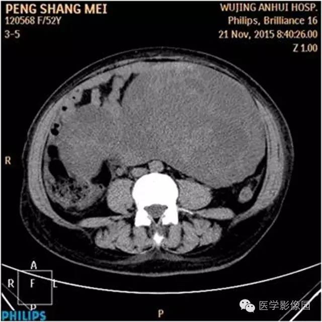 【病例】腹盆腔巨大转移瘤1例CT影像表现 【病例】腹盆腔巨大转移瘤1例CT影像表现