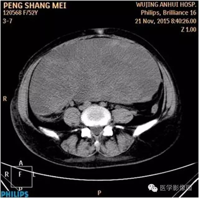 【病例】腹盆腔巨大转移瘤1例CT影像表现 【病例】腹盆腔巨大转移瘤1例CT影像表现