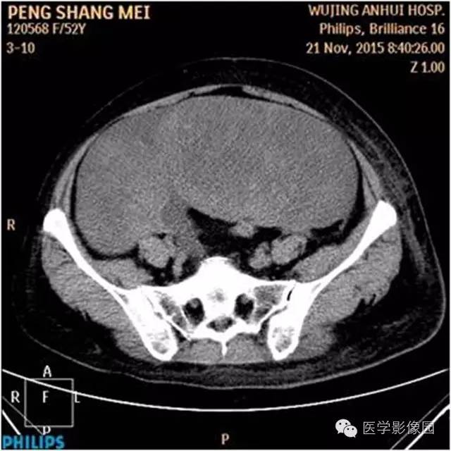 【病例】腹盆腔巨大转移瘤1例CT影像表现 【病例】腹盆腔巨大转移瘤1例CT影像表现
