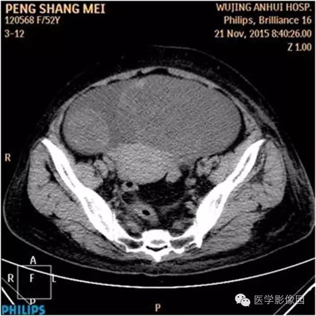 【病例】腹盆腔巨大转移瘤1例CT影像表现 【病例】腹盆腔巨大转移瘤1例CT影像表现