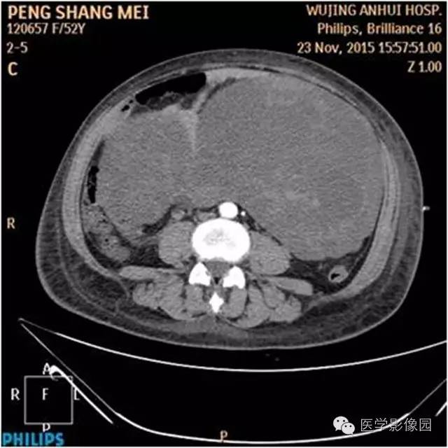 【病例】腹盆腔巨大转移瘤1例CT影像表现 【病例】腹盆腔巨大转移瘤1例CT影像表现