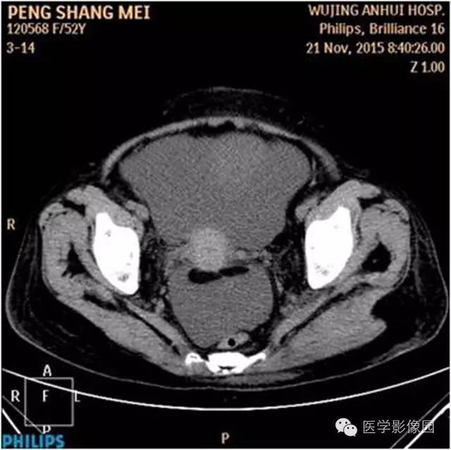 【病例】腹盆腔巨大转移瘤1例CT影像表现 【病例】腹盆腔巨大转移瘤1例CT影像表现