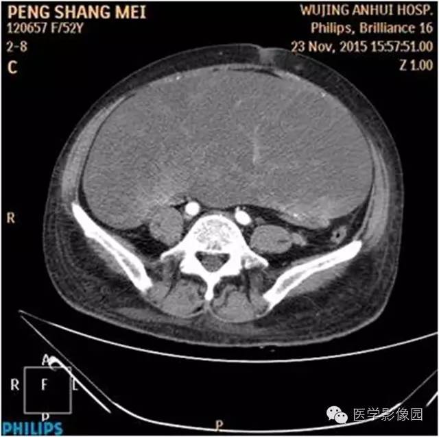 【病例】腹盆腔巨大转移瘤1例CT影像表现 【病例】腹盆腔巨大转移瘤1例CT影像表现