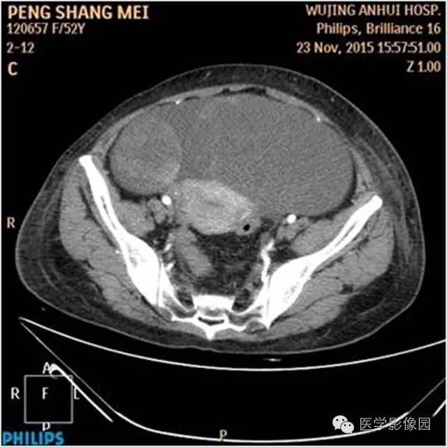 【病例】腹盆腔巨大转移瘤1例CT影像表现 【病例】腹盆腔巨大转移瘤1例CT影像表现