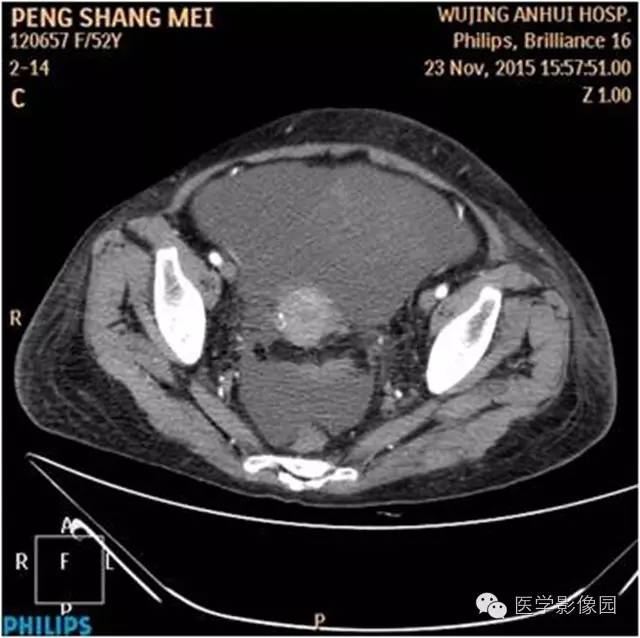 【病例】腹盆腔巨大转移瘤1例CT影像表现 【病例】腹盆腔巨大转移瘤1例CT影像表现