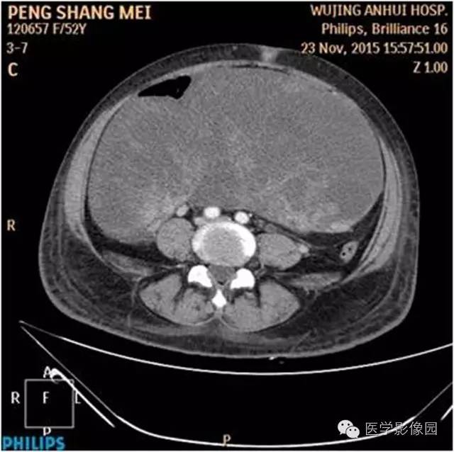 【病例】腹盆腔巨大转移瘤1例CT影像表现 【病例】腹盆腔巨大转移瘤1例CT影像表现