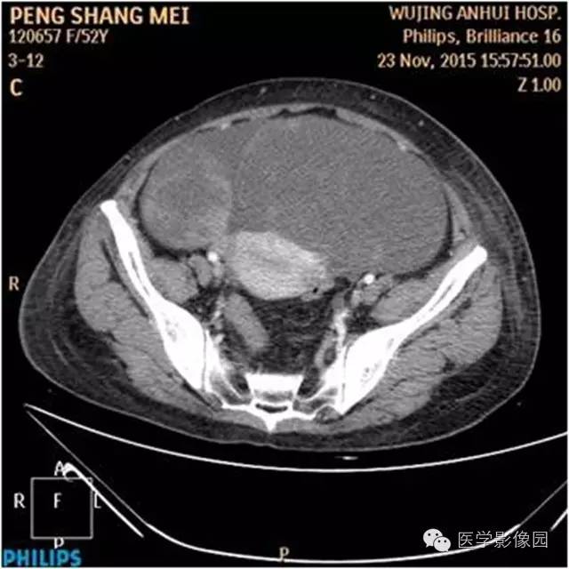【病例】腹盆腔巨大转移瘤1例CT影像表现 【病例】腹盆腔巨大转移瘤1例CT影像表现