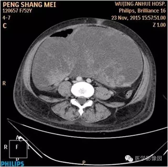 【病例】腹盆腔巨大转移瘤1例CT影像表现 【病例】腹盆腔巨大转移瘤1例CT影像表现