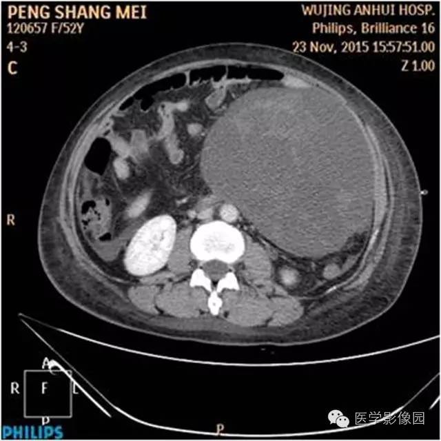 【病例】腹盆腔巨大转移瘤1例CT影像表现 【病例】腹盆腔巨大转移瘤1例CT影像表现
