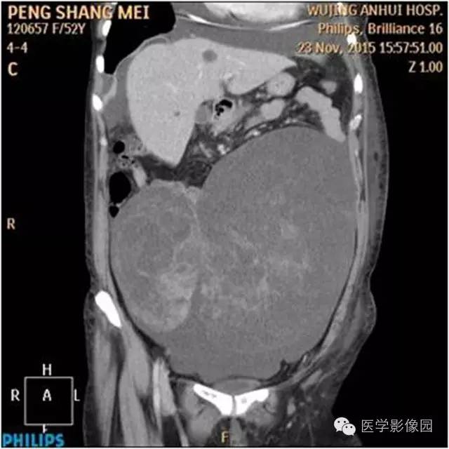 【病例】腹盆腔巨大转移瘤1例CT影像表现 【病例】腹盆腔巨大转移瘤1例CT影像表现