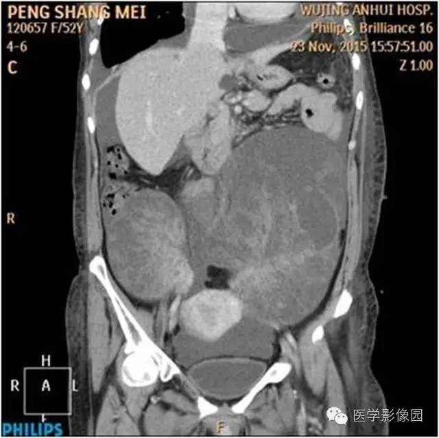 【病例】腹盆腔巨大转移瘤1例CT影像表现 【病例】腹盆腔巨大转移瘤1例CT影像表现