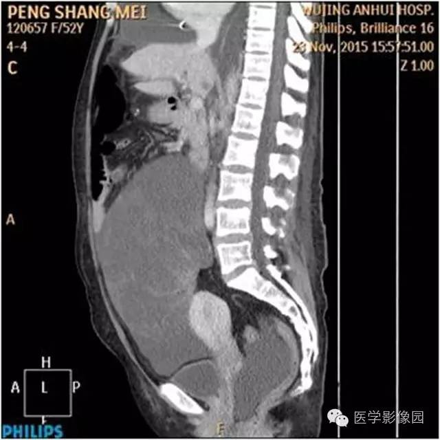 【病例】腹盆腔巨大转移瘤1例CT影像表现 【病例】腹盆腔巨大转移瘤1例CT影像表现