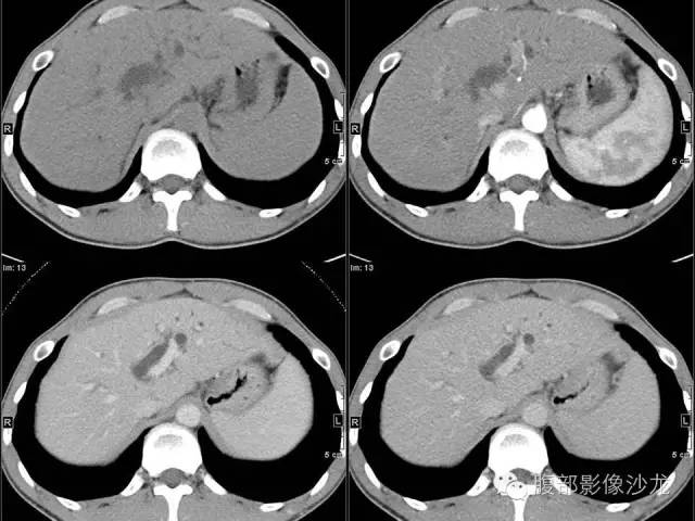 【病例】胰腺实性假乳头状瘤1例CT影像表现 【病例】胰腺实性假乳头状瘤1例CT影像表现