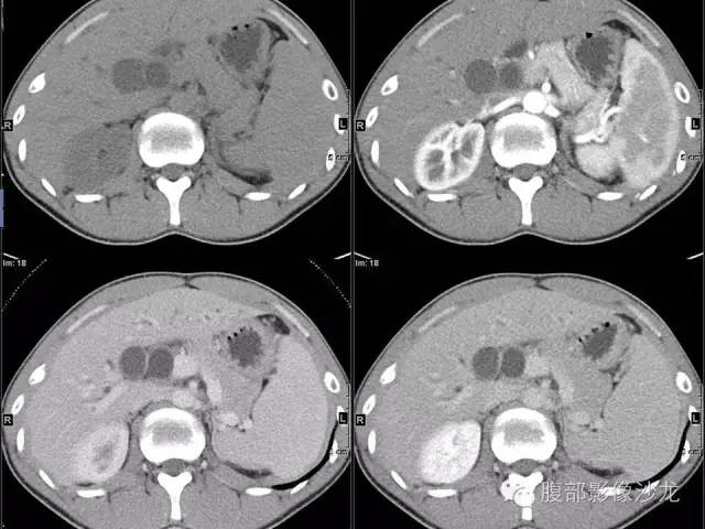 【病例】胰腺实性假乳头状瘤1例CT影像表现 【病例】胰腺实性假乳头状瘤1例CT影像表现