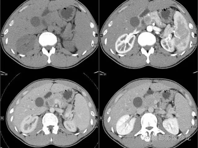 【病例】胰腺实性假乳头状瘤1例CT影像表现 【病例】胰腺实性假乳头状瘤1例CT影像表现