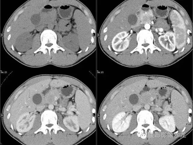 【病例】胰腺实性假乳头状瘤1例CT影像表现 【病例】胰腺实性假乳头状瘤1例CT影像表现