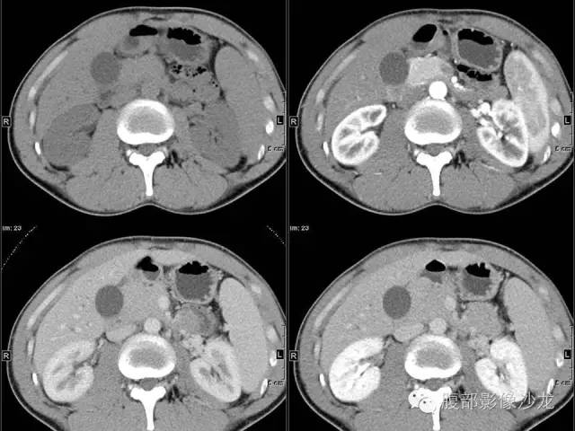 【病例】胰腺实性假乳头状瘤1例CT影像表现 【病例】胰腺实性假乳头状瘤1例CT影像表现