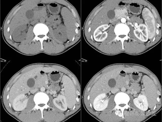【病例】胰腺实性假乳头状瘤1例CT影像表现 【病例】胰腺实性假乳头状瘤1例CT影像表现
