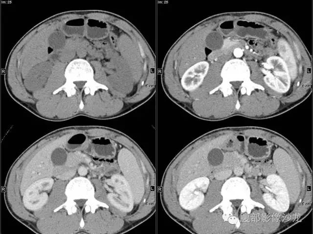 【病例】胰腺实性假乳头状瘤1例CT影像表现 【病例】胰腺实性假乳头状瘤1例CT影像表现