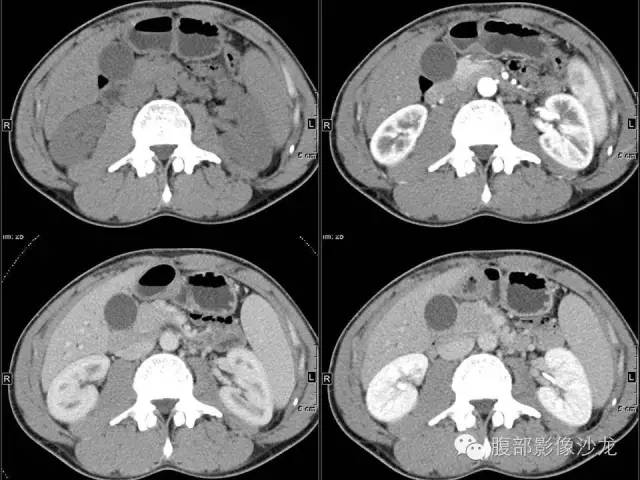 【病例】胰腺实性假乳头状瘤1例CT影像表现 【病例】胰腺实性假乳头状瘤1例CT影像表现