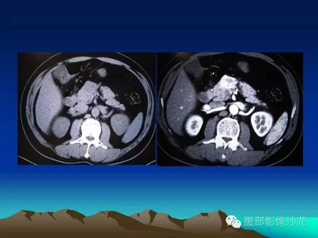 【病例】胰腺实性假乳头状瘤1例CT影像表现 【病例】胰腺实性假乳头状瘤1例CT影像表现