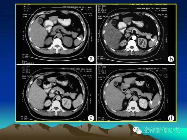 【病例】胰腺实性假乳头状瘤1例CT影像表现 【病例】胰腺实性假乳头状瘤1例CT影像表现