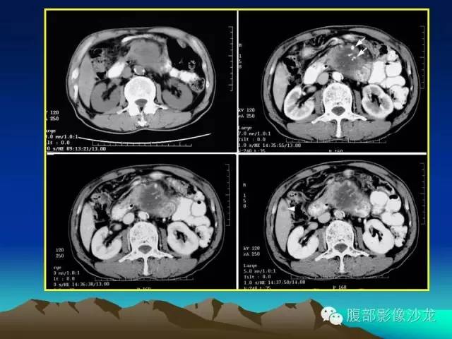 【病例】胰腺实性假乳头状瘤1例CT影像表现 【病例】胰腺实性假乳头状瘤1例CT影像表现