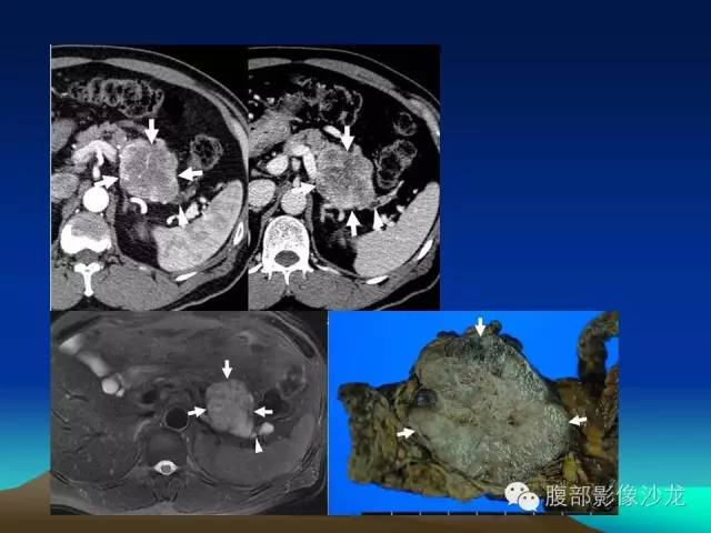 【病例】胰腺实性假乳头状瘤1例CT影像表现 【病例】胰腺实性假乳头状瘤1例CT影像表现