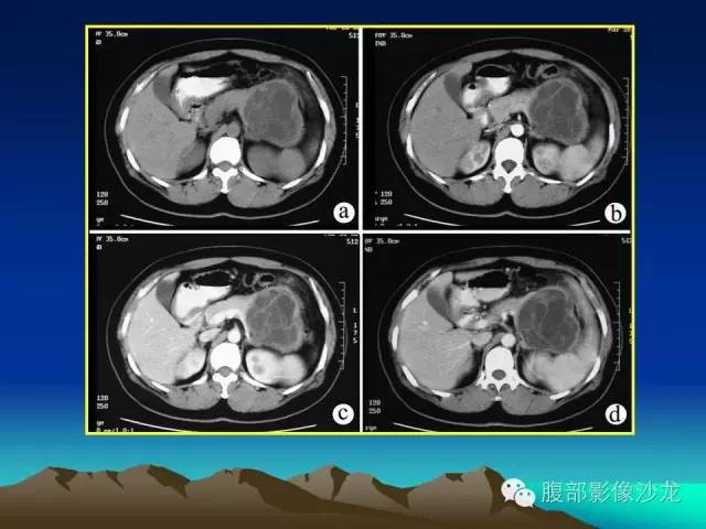 【病例】胰腺实性假乳头状瘤1例CT影像表现 【病例】胰腺实性假乳头状瘤1例CT影像表现