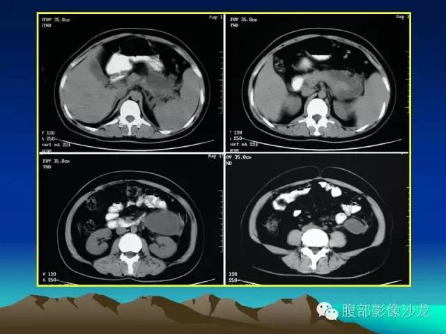 【病例】胰腺实性假乳头状瘤1例CT影像表现 【病例】胰腺实性假乳头状瘤1例CT影像表现