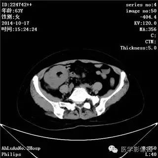 【病例】小肠淋巴瘤1例CT影像表现 【病例】小肠淋巴瘤1例CT影像表现