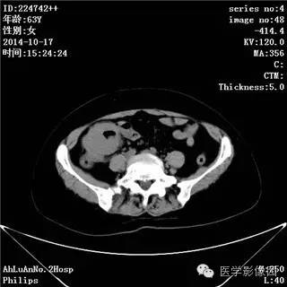 【病例】小肠淋巴瘤1例CT影像表现
