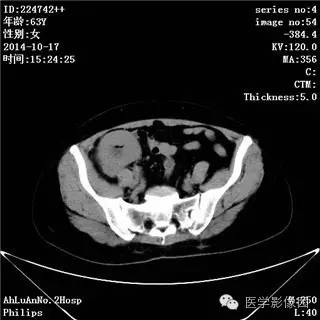 【病例】小肠淋巴瘤1例CT影像表现 【病例】小肠淋巴瘤1例CT影像表现