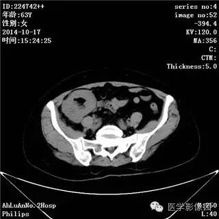 【病例】小肠淋巴瘤1例CT影像表现 【病例】小肠淋巴瘤1例CT影像表现