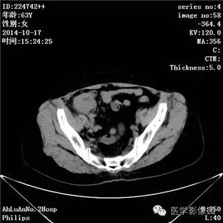 【病例】小肠淋巴瘤1例CT影像表现 【病例】小肠淋巴瘤1例CT影像表现
