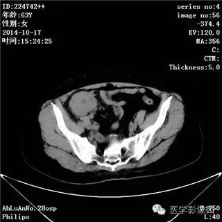 【病例】小肠淋巴瘤1例CT影像表现 【病例】小肠淋巴瘤1例CT影像表现