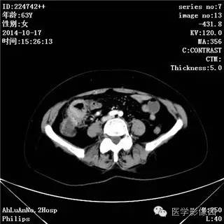 【病例】小肠淋巴瘤1例CT影像表现 【病例】小肠淋巴瘤1例CT影像表现
